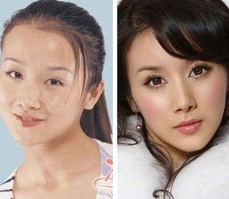 整容失败明星对比照,揭秘美丽背后的代价